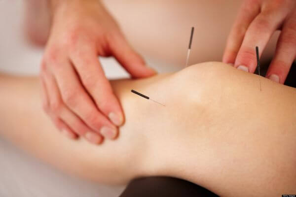 acupuncture for joint pain