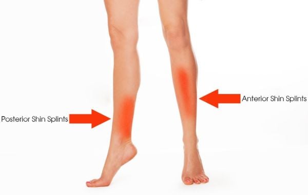 shin splints posterior anterior pain