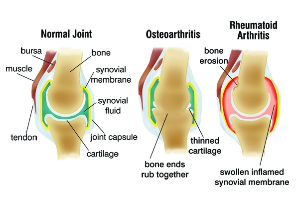 what is arthritis