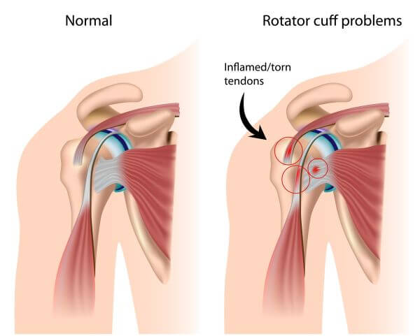 rotator cuff injury