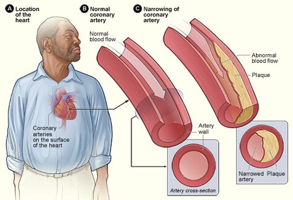 Low-density lipoproteins