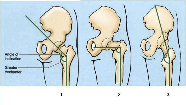 sumo deadlift femur angle