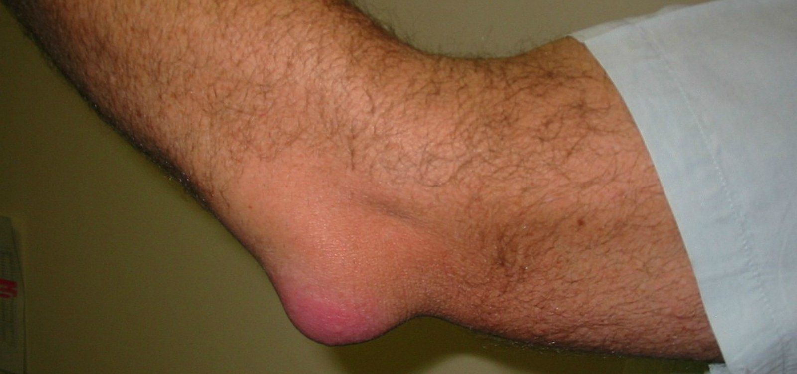 elbow pain treatment