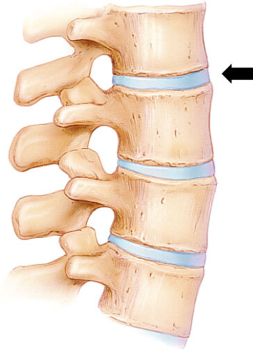 lower back pain relief spinal discs