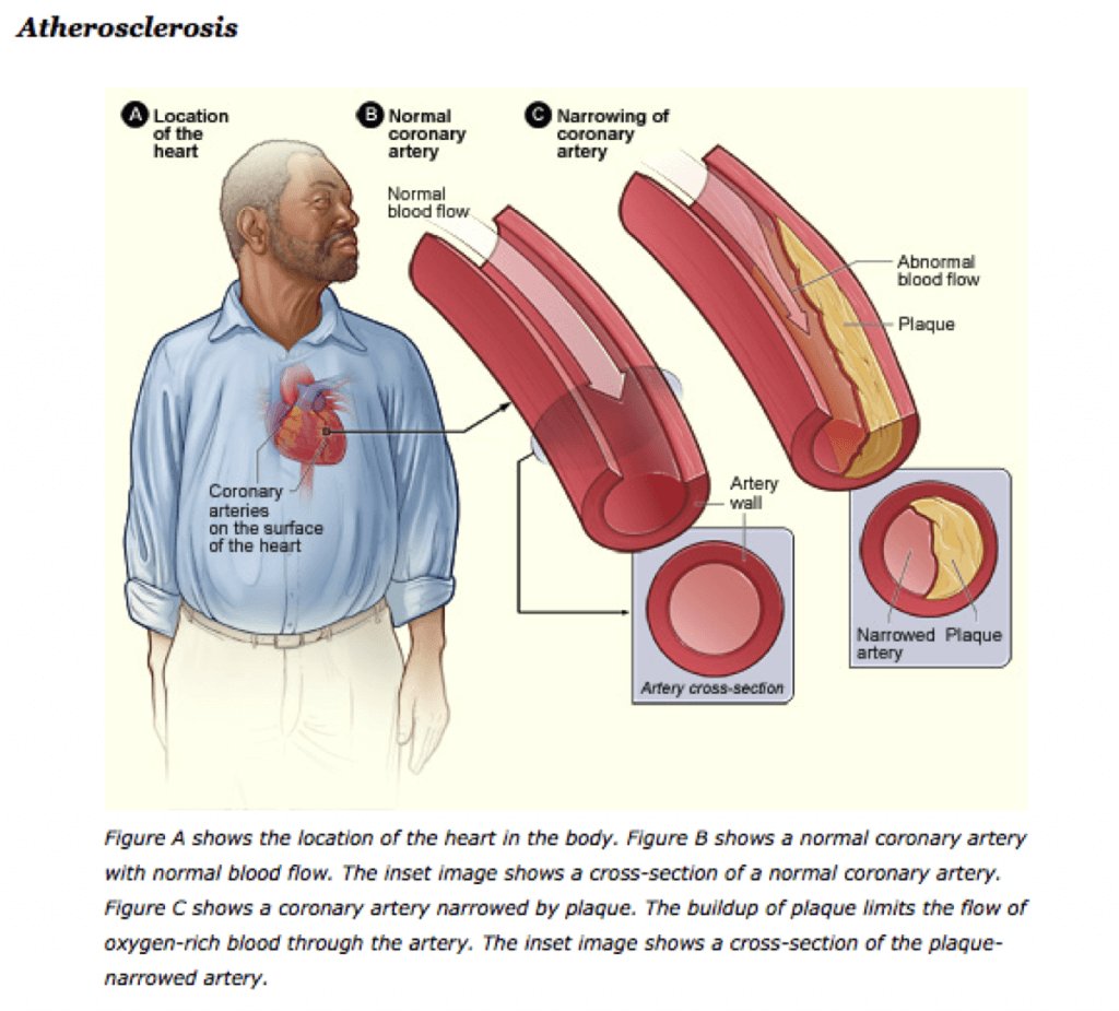 Athersclerosis