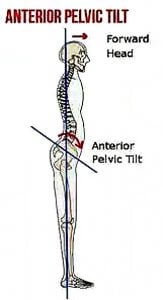 anterior-pelvic-tilt-symptoms