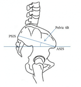 do-i-have-anterior-pelvic-tilt