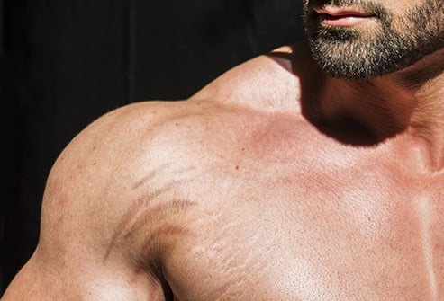 493ss_thinkstock_rf_bodybuilder_shoulder_close_up.jpg