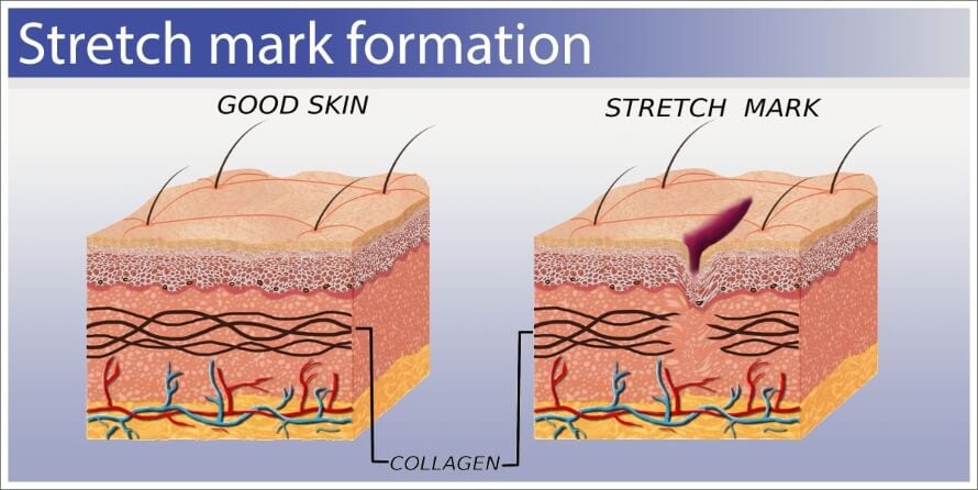 Muscle Stretch Marks: How to Prevent Strength Marks from Working Out ...