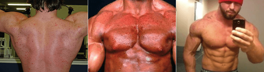 The Best 5 Examples Of steroids and constipation