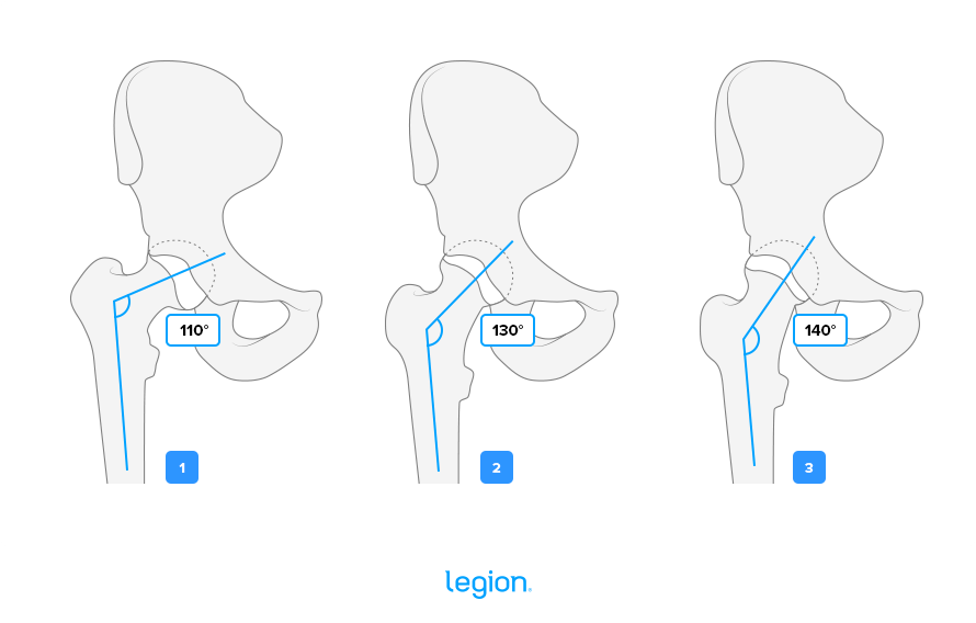 Femur Angle