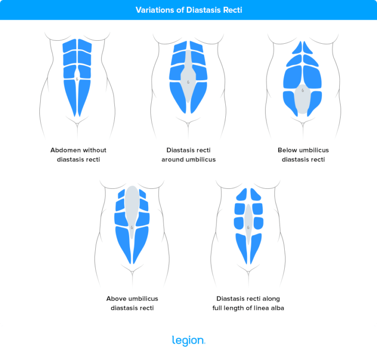 Diastasis Recti Exercises Everything You Need to Know About How to Fix