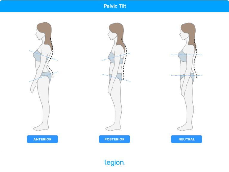 Anterior Pelvic Tilt Fixes Symptoms And Exercises An Evidence Based Guide Legion 