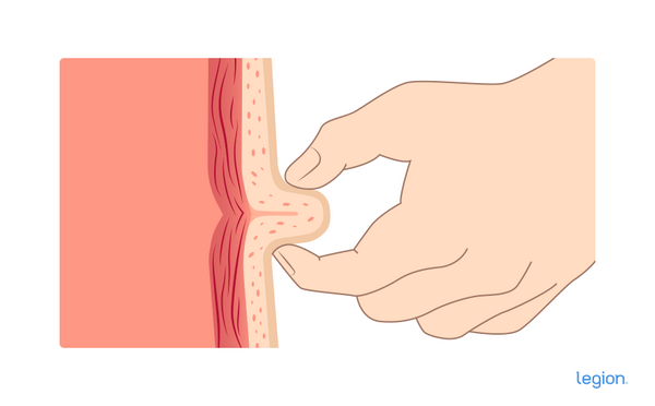 Skinfold Body Fat Test. Measuring Body Fat on Subscapular Tissue