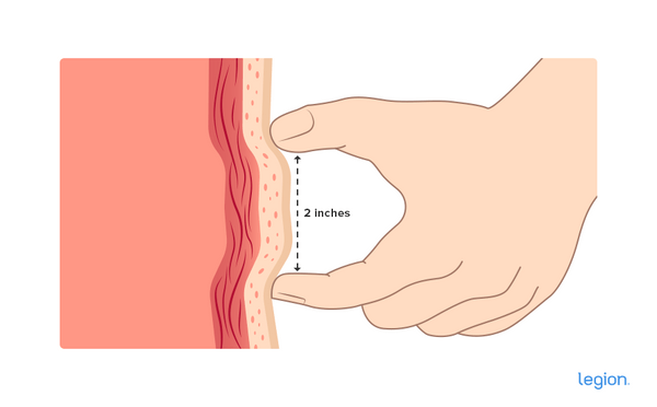 Skin pinch test to determine the thickness of adipose tissue on the back