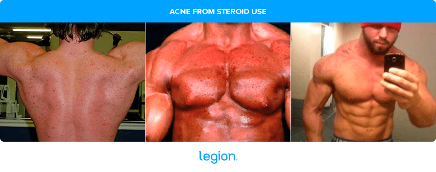 Acne from Steroid Use (Winstrol)