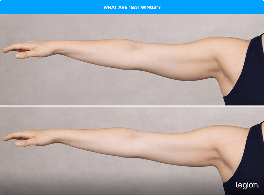 What Are “Bat Wings”?