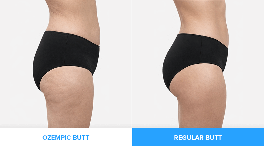 Diagram showing what Ozempic butt is vs. a regular butt.