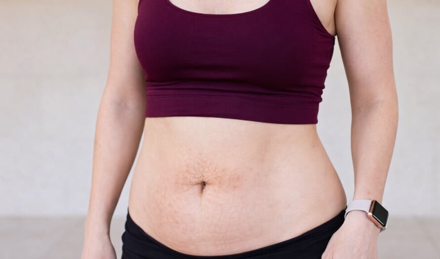 Postpartum lower belly showing a typical mom pooch caused by stretched tissue, body fat, and possible diastasis recti. 