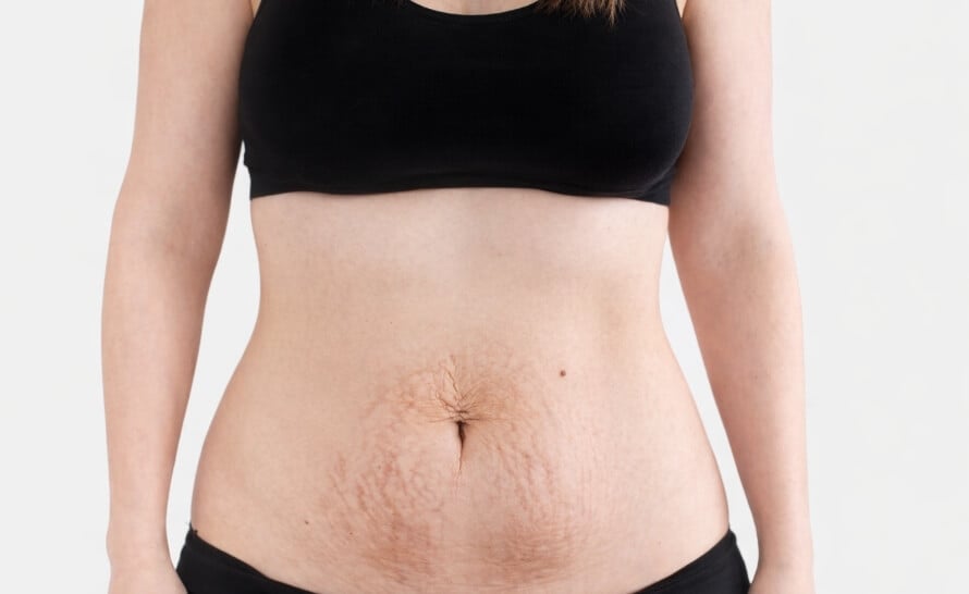 Close-up of a postpartum stomach illustrating what a mom pooch looks like, including lower belly protrusion and abdominal wall changes.